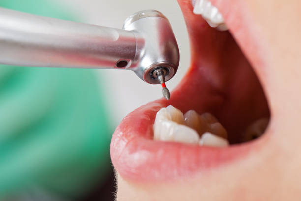 Best Emergency Wisdom Teeth Removal in Riverton, IL
